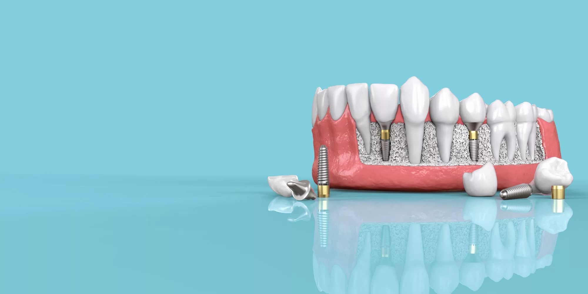 Зуба без рекламы. Зубной имплант dentis. Имплантаты Dentium Superline. Зубные имплантаты Straumann. Креативная реклама стоматологии.
