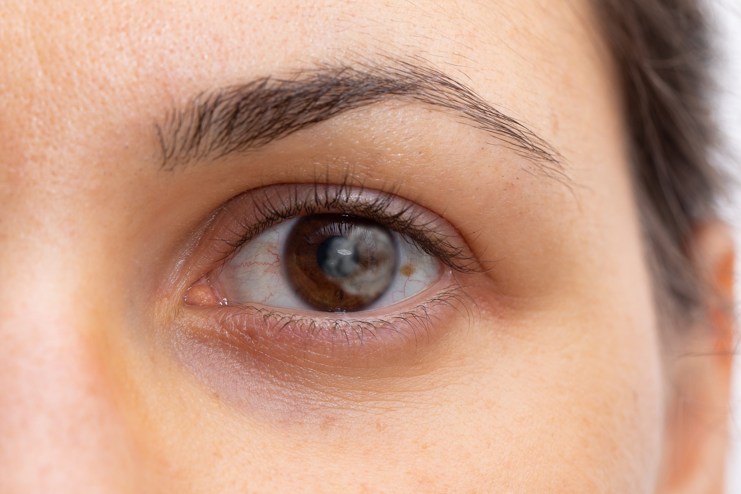 Точки около глаз. Лимбальный кератоконъюнктивит. В белках глаз тёмные пятнышки.