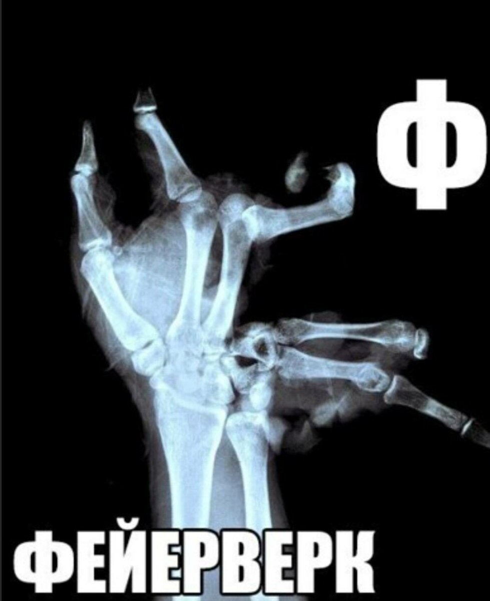 Рентген руки после петарды