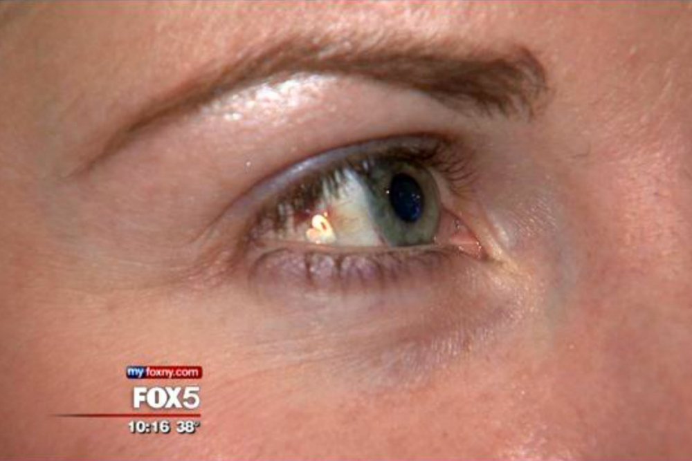 Коричневое пятно на белке глаза