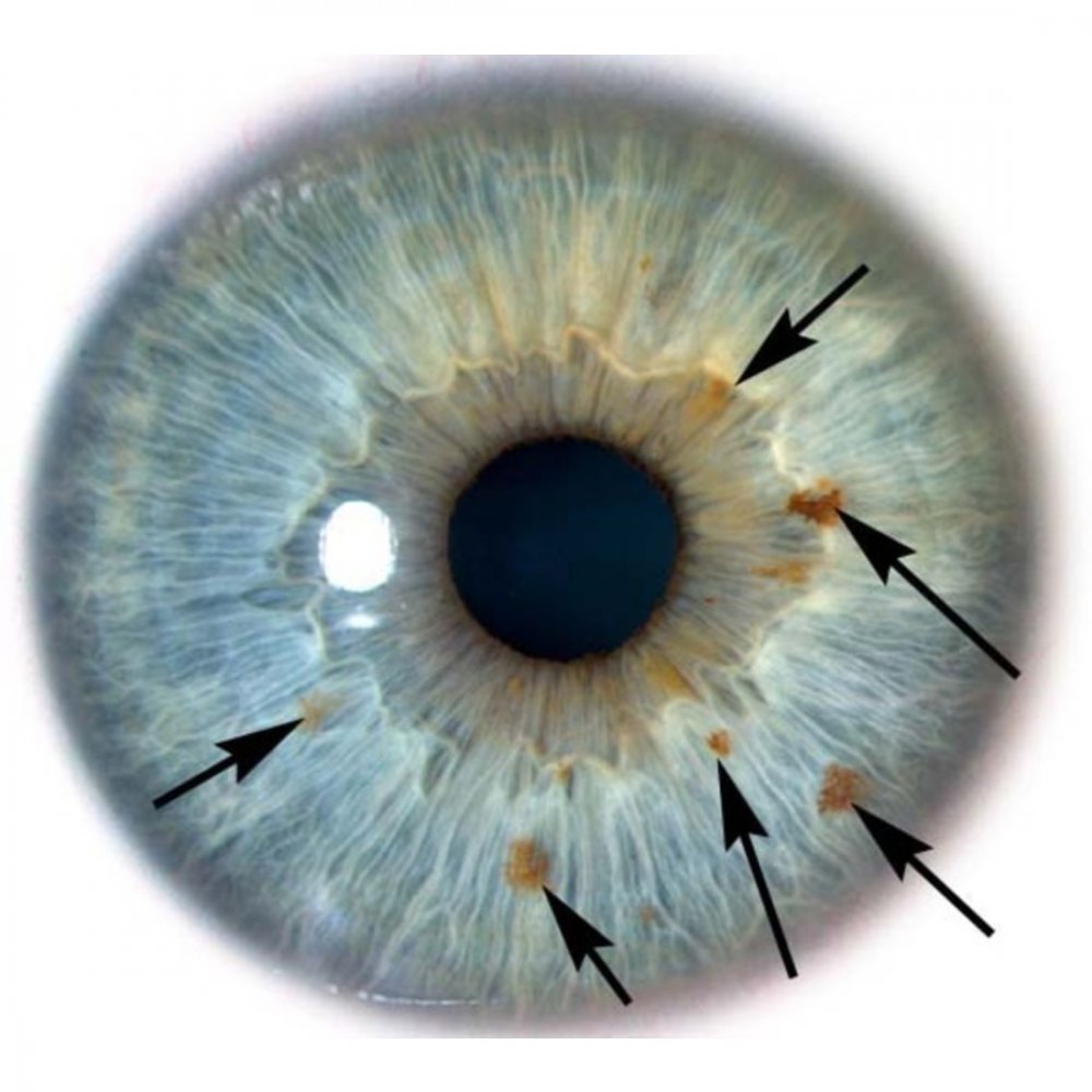 Диагностика по радужке глаза иридодиагностика