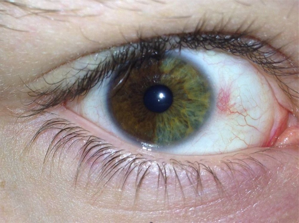 Гетерохромия радужной оболочки глаз