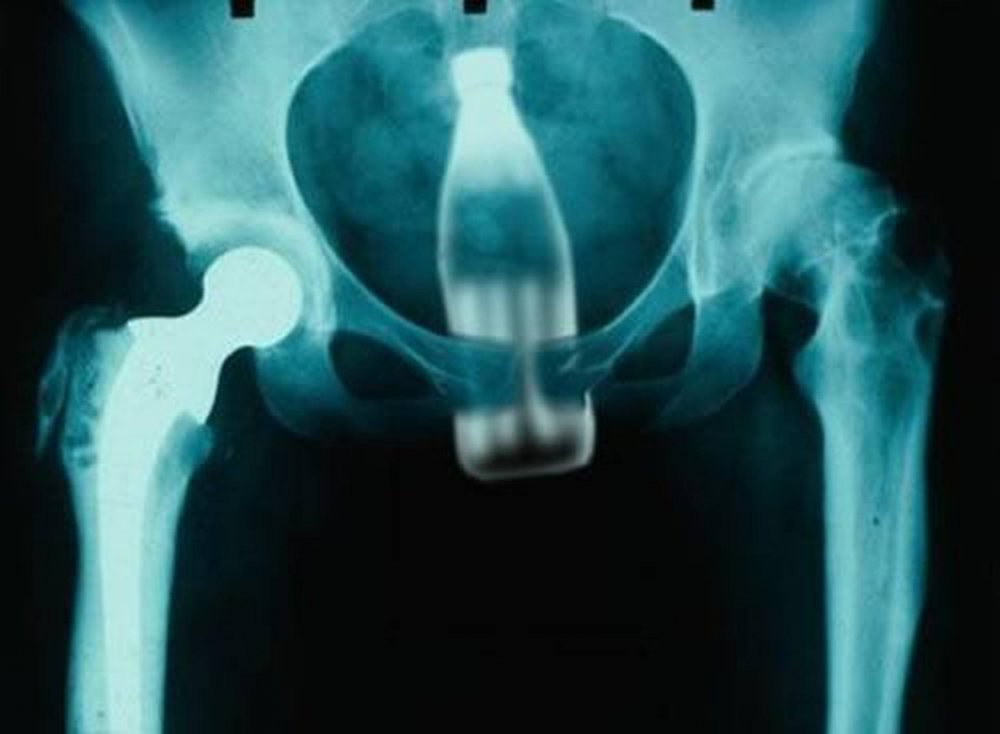 Рентген снимки задницы