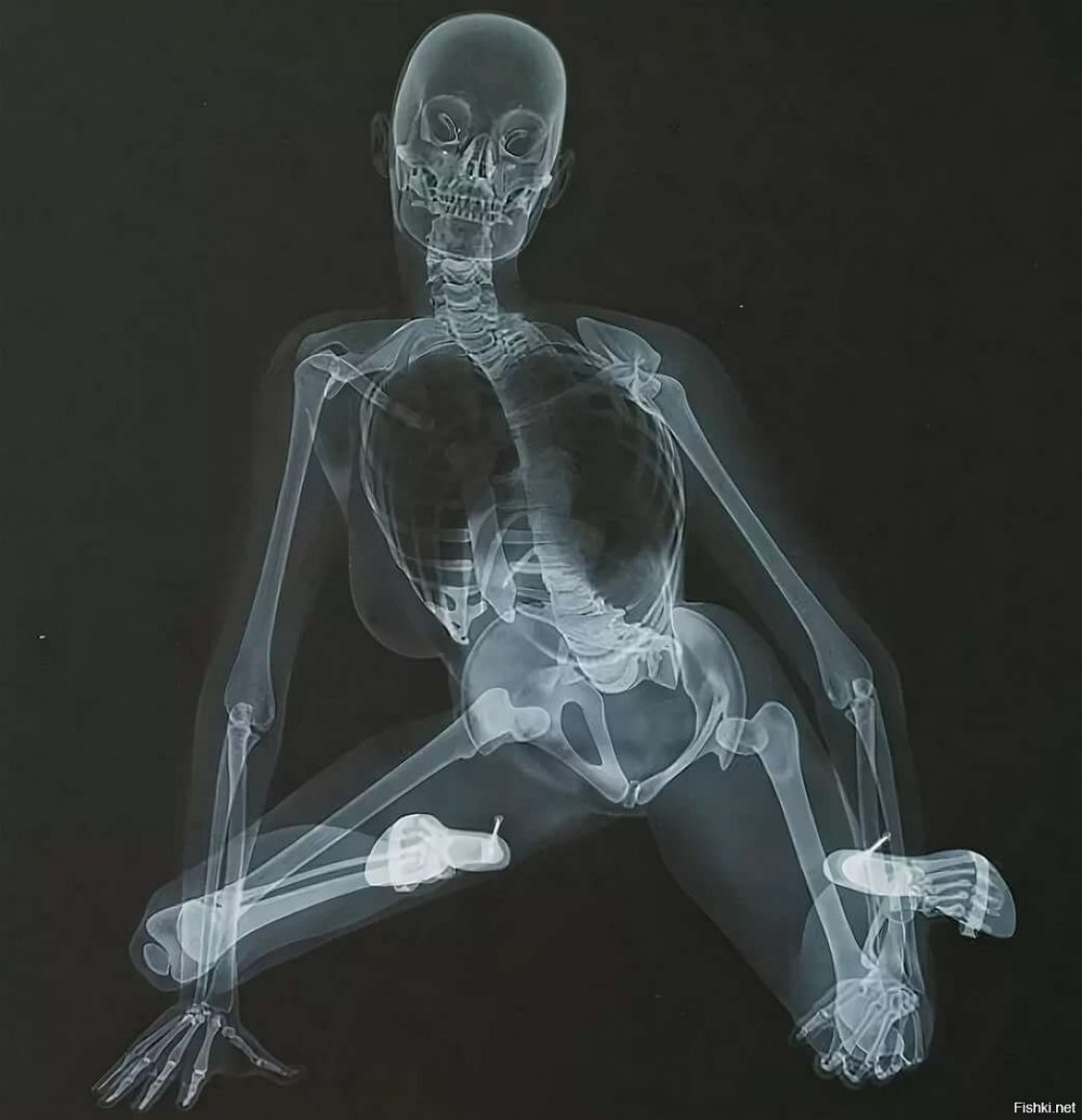 Рентгеновский снимок девушки